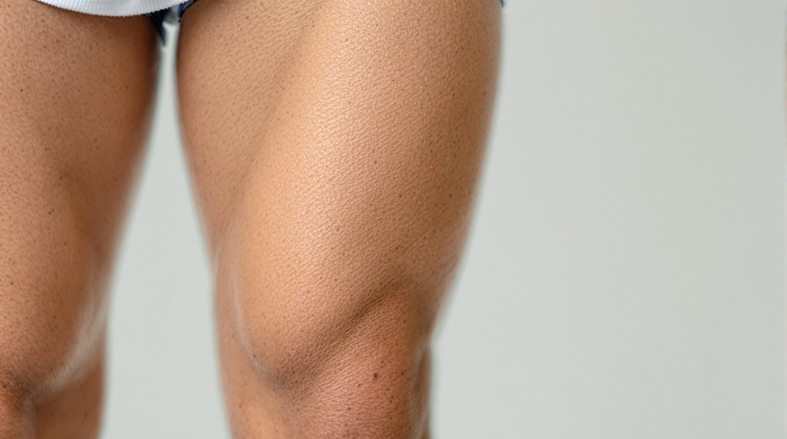 Vergetures sur les cuisses chez les hommes : causes, traitements et prévention - Healthy Passion